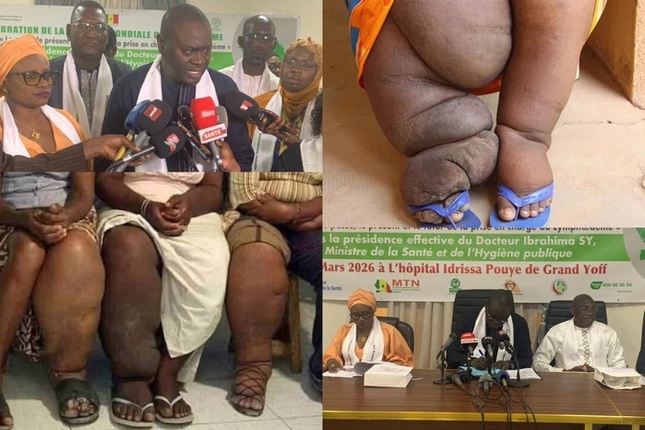  Santé : Le Sénégal célèbre une première journée mondiale du Lymphœdème et appelle à une prise en charge accessible 