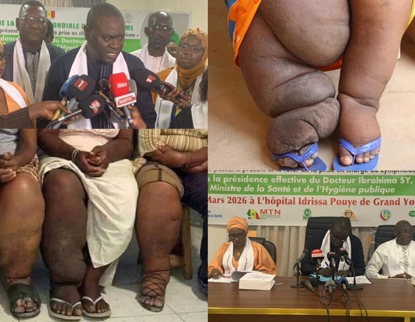  Santé : Le Sénégal célèbre une première journée mondiale du Lymphœdème et appelle à une prise en charge accessible 