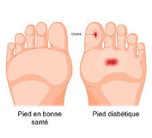 L'impact du stress sur la santé des diabétiques : un appel à une prise en charge renforcée